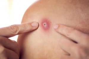 Duży pryszcz, czyrak, ropień… Jak je rozpoznać i skutecznie leczyć?